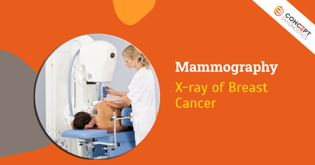 Mammography: X-ray of Breast